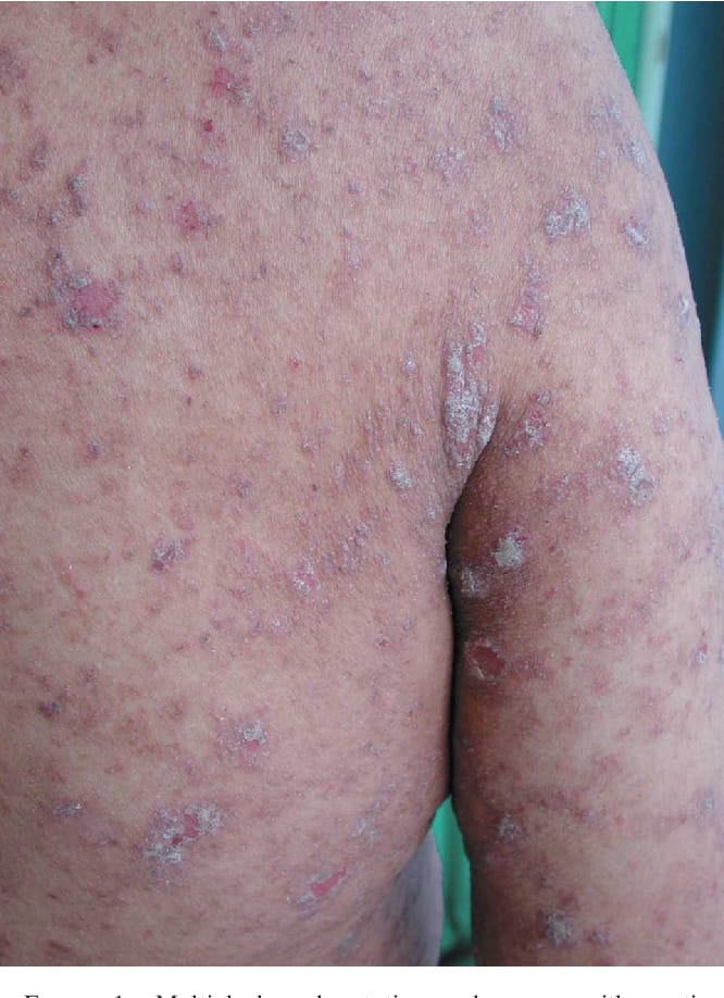 SCABIES - खरुज